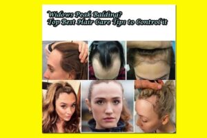 Widows Peak Balding - 7 Top Best Hair Care Tips